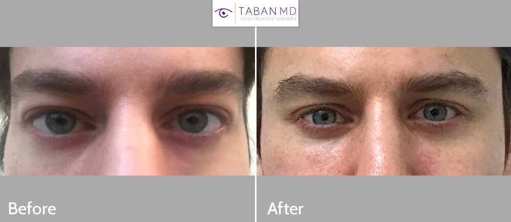 Cosmetic orbital decompression bulging eye surgery Before and After Patient 39 Dr Taban 1