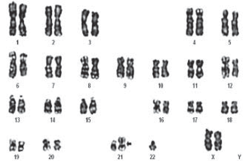 Karyotype showing 45 XX rob 21 22 chromosome constitution in a female partner with
