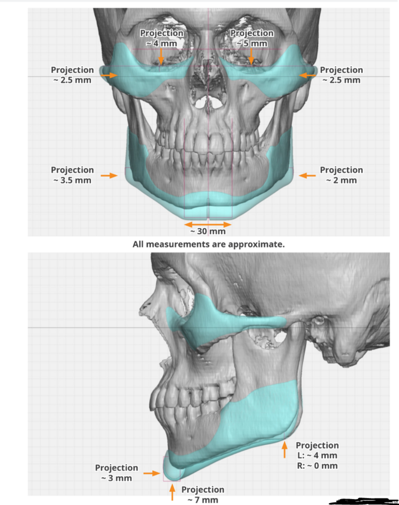 Dr Eppley implants