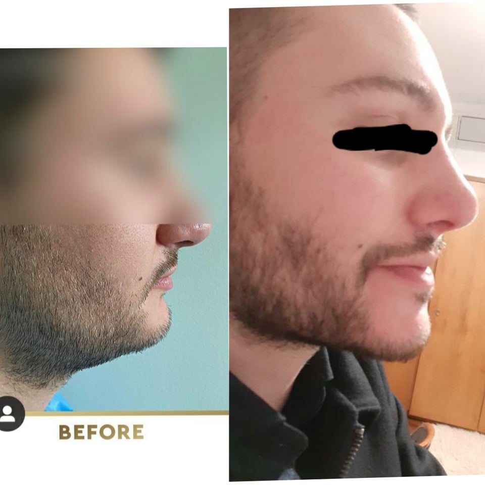 Sliding genioplasty  submental lipo results 1 hour before surgery vs 3 weeks post op