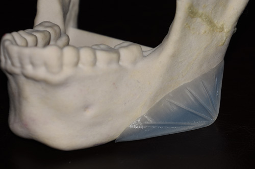 Vertical Lengthening Jaw Angle Implants Design Dr Barry Eppley Indianapolis