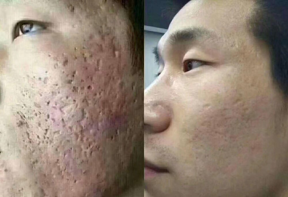 Acne scars treatment 1559001028 22a21e5f progressive