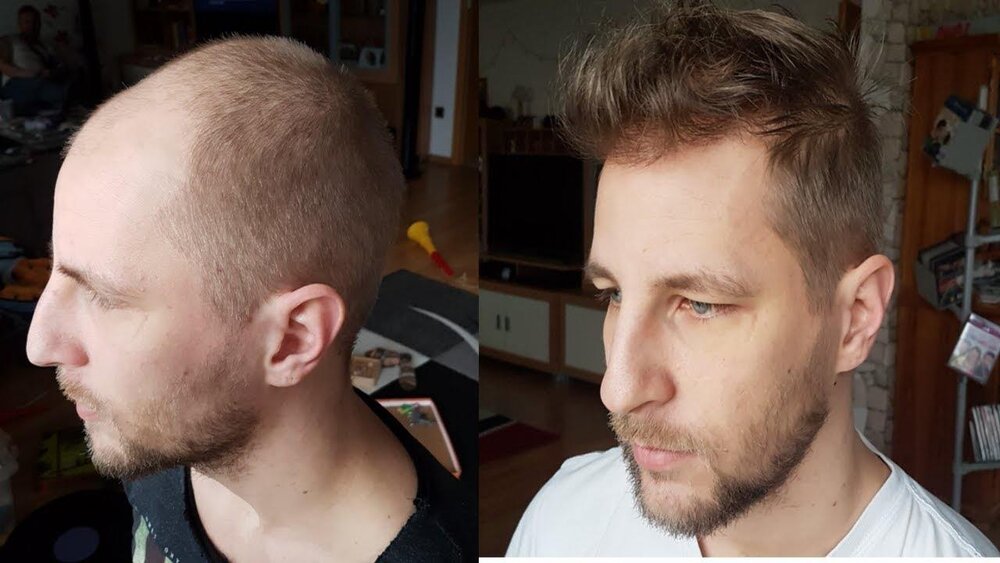 Die haartransplantation erfahrungen von youtuber meezy beezy