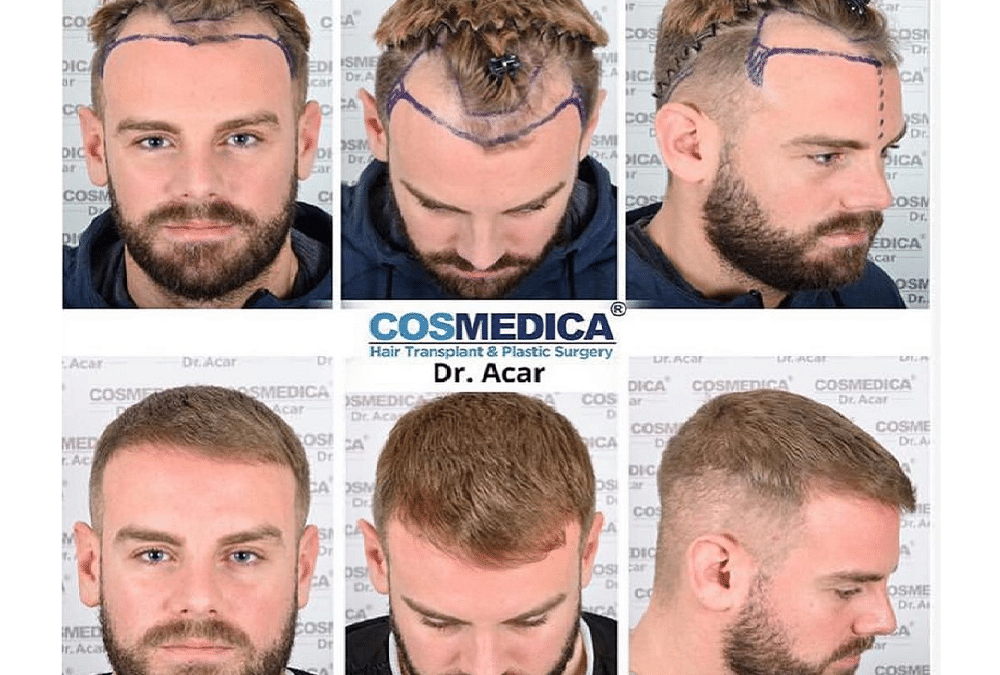 Haartransplantation Turkei vorher nachher 1000x675