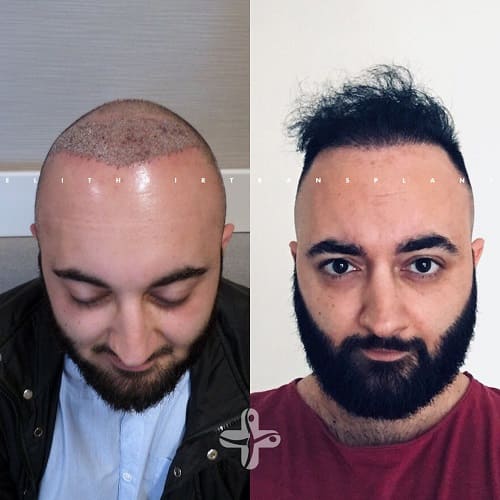 Haartransplantation in der Turkei vorher nachher 10