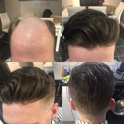Hair Replacement in Dubai Abu Dhabi Sharjah