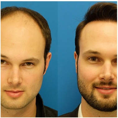 Hair transplant 500x500
