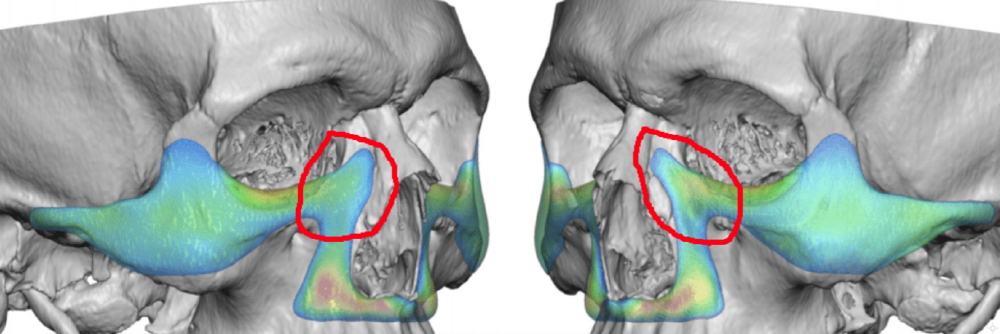 Eppley implant8