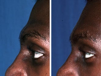 Male Brow Temple1 46889