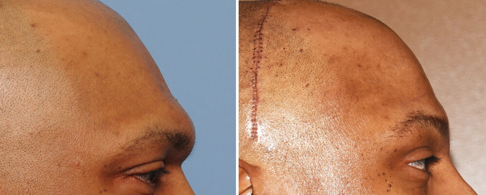 Male Brow Bone reduction through coronal incision result side view Dr Barry Eppley Indianapolis