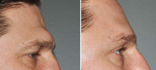 Male Brow Bone Reduction result side view Dr Barry Eppley Indianapolsi 1