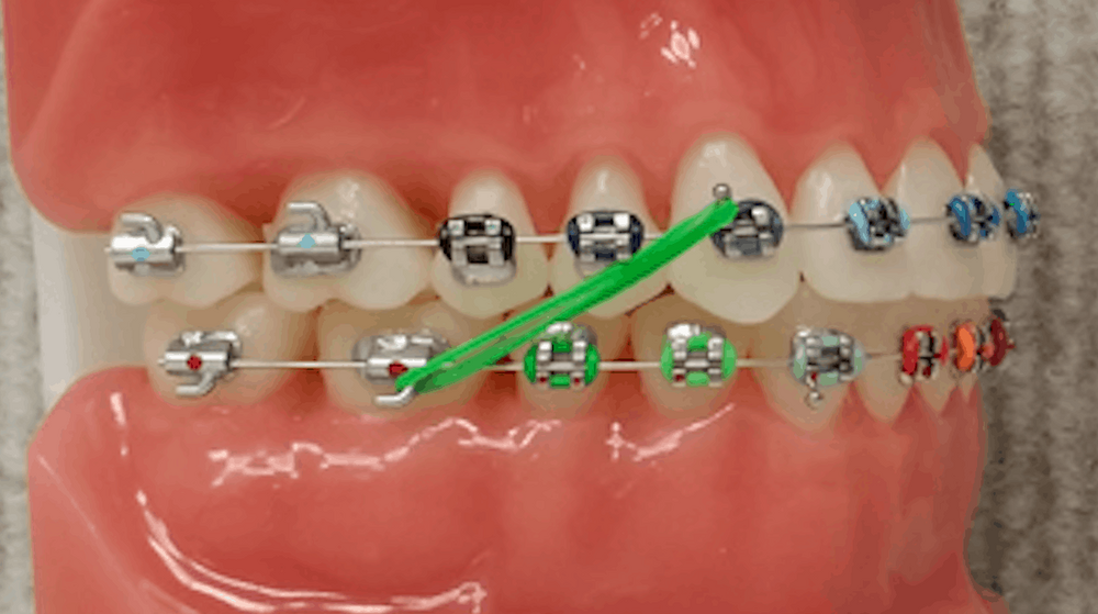 Colored Elastics Marin Ortho