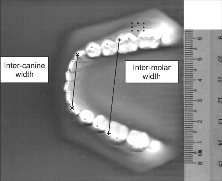 Example of inter canine and inter molar width measurements used to compare arch