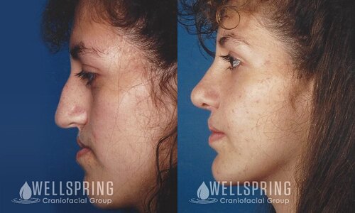 Unilateral-Cleft-Lip-and-Palate-Austin-Patient-1.1.jpg
