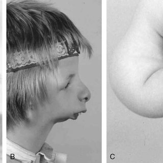 Clinical photos of patients 1 and 2 The mandibular micrognatia and malar hypoplasia are Q320