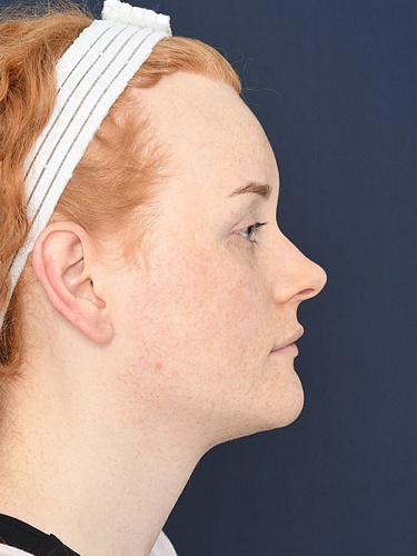 Marked Brow Ridge Importance of the brow ridge / bone | Looksmax.org - Men's Self ...