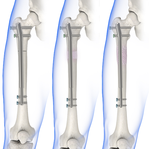 NuVasive Precice Femur Sequence