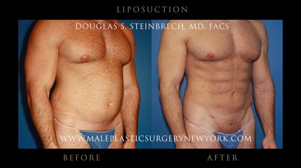 Liposuction surgery cost in NYC by body area 1024x571