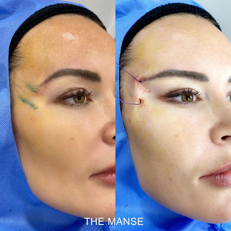 Before and after foxy eye threadlift sydney australia 800x800