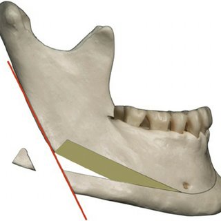Former design of the chin wing osteotomy In patients with hyperdivergent skeletal class Q320