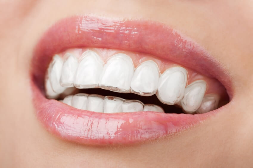 Invisalign1