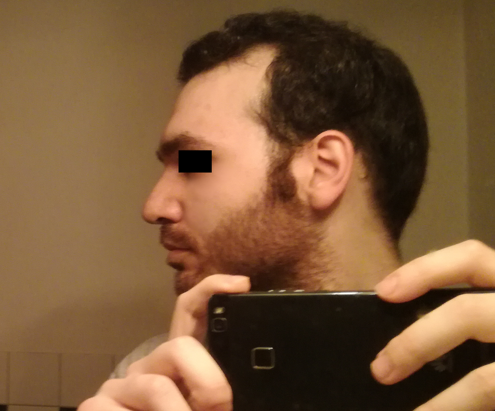 New nose