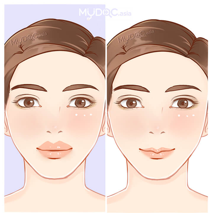 Procedures icon lip reduction