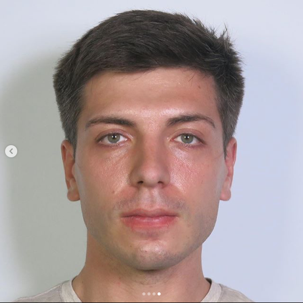 13months post op