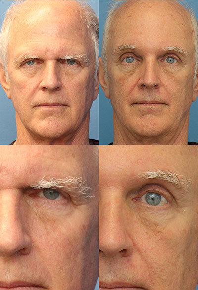 1587509890 browlift thumb