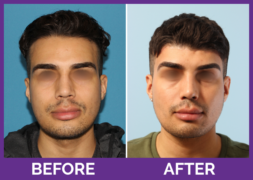 Foreheadreduction reginarodmanmd 2