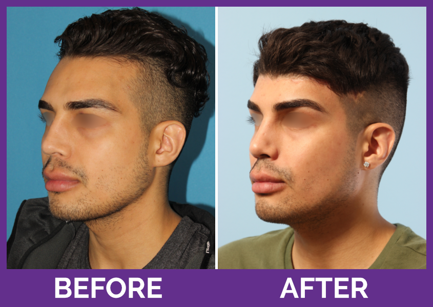 Foreheadreduction reginarodmanmd 1