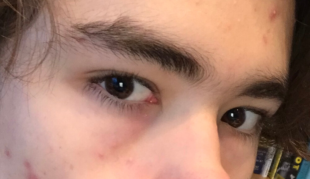 Eye area