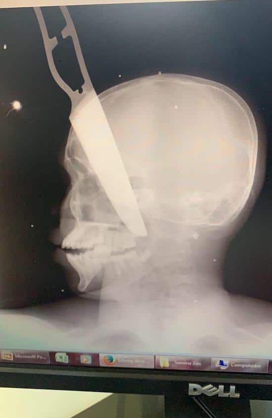 Man stabbed head angola x ray