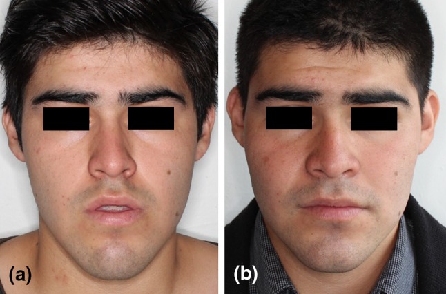 A Presurgical frontal view b postsurgical frontal view