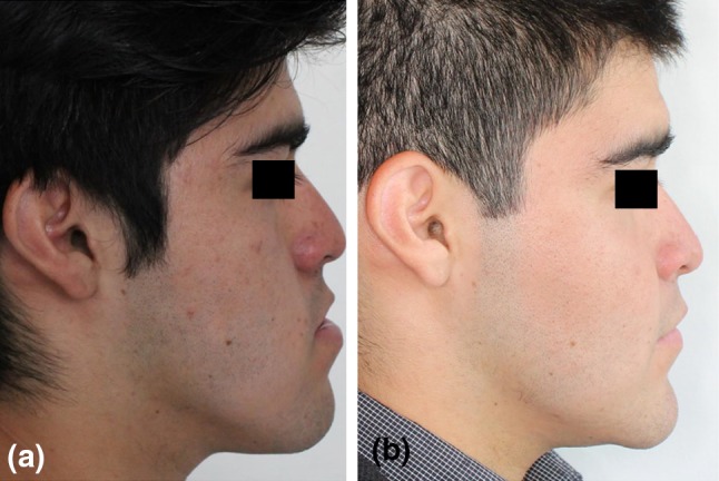 A Presurgical right lateral view b postsurgical right lateral view