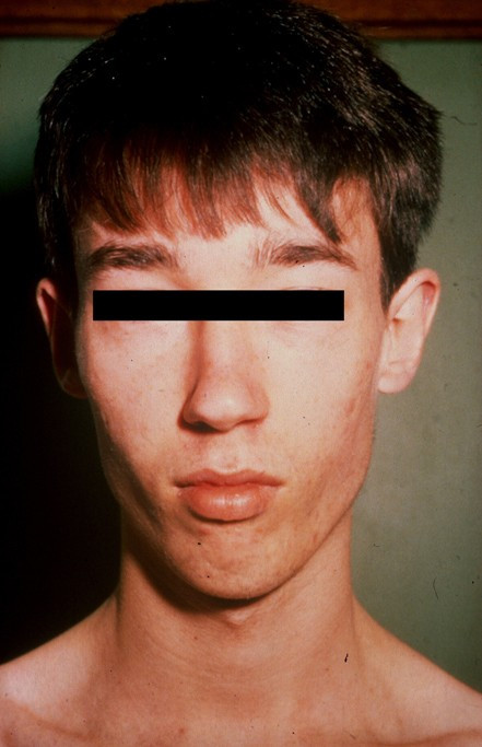 Lujan Fryns syndrome note the long narrow face maxillary hypoplasia small mandible