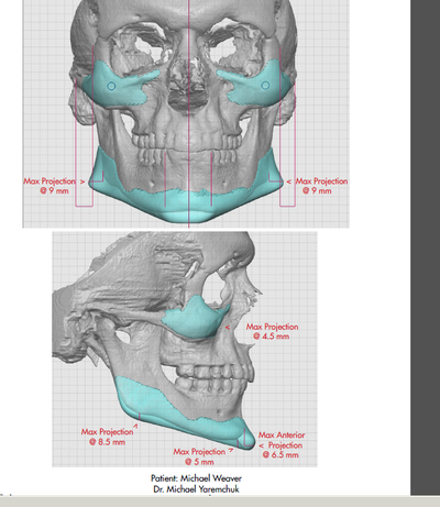 Yaremchuk ct after for custom jaw and zygo copy
