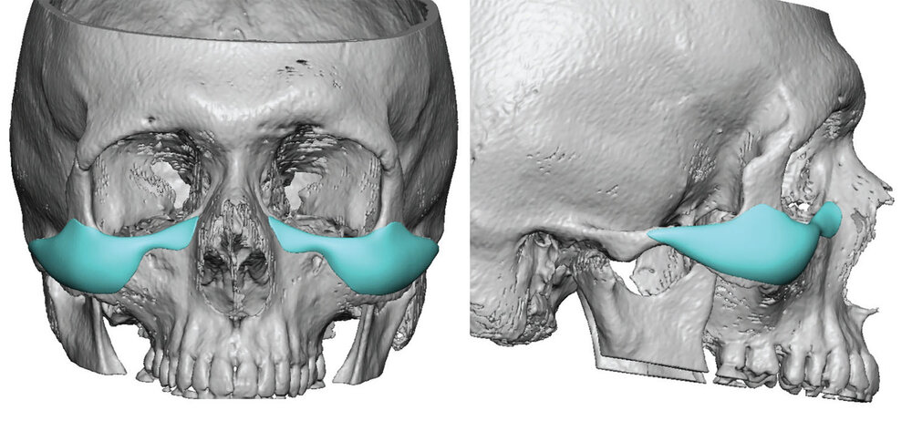 Ct front side HD