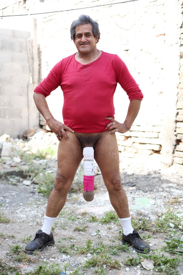 Half metre member man with the worlds biggest penis refuses a reduction3 orig