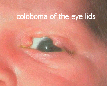 Coloboma of the eye lids