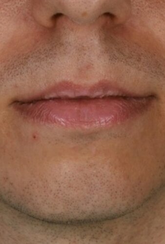 Philtrum 2