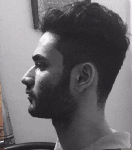 Mewing before after result