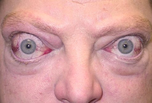 Bulging eyes 1
