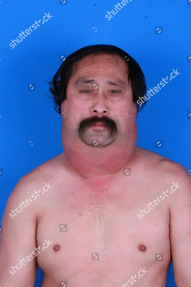 Alcoholics drinking causes him to develop a super thick neck shenyang liaoning province china 