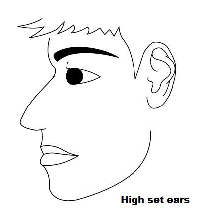 High set ears