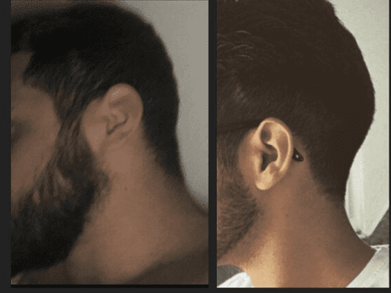 Neck extension 2 years