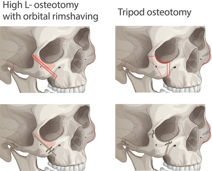 Tripod osteotomy