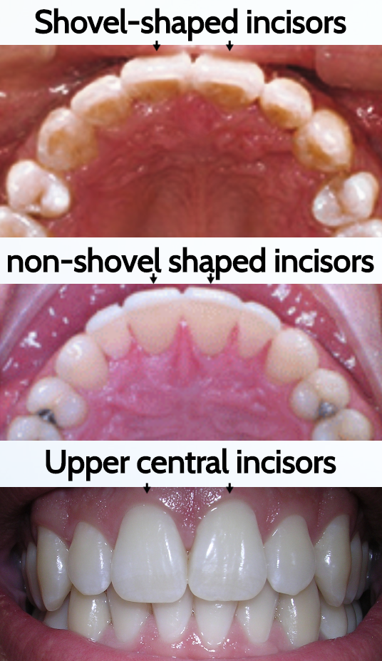Shovel shaped incisors