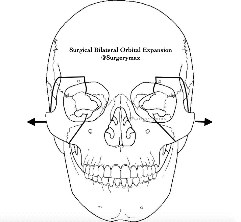 Procedure N1