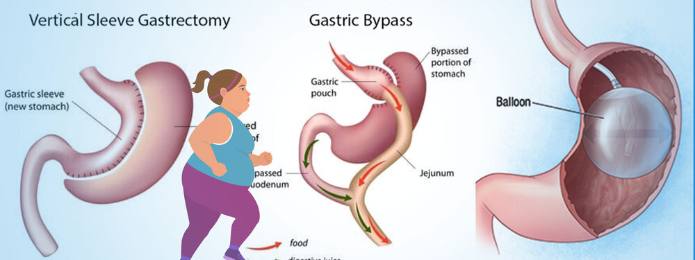 Bariatric Surgery